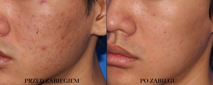 Przed i po Dermapenie