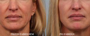 Przed i po zabiegiem Emerge+Dermapen