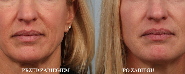 Przed i po zabiegiem Emerge+Dermapen